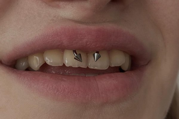smiley piercing pros and cons