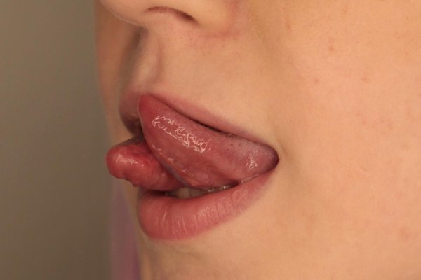 Tongue splitting