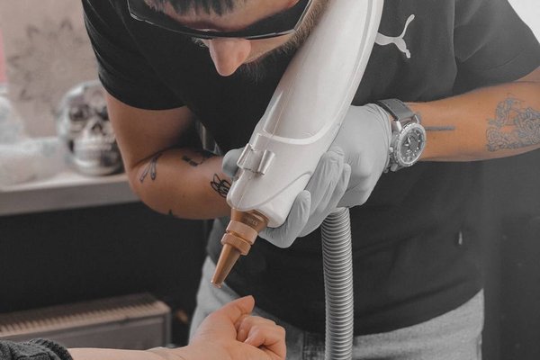 Tattoo removal in Wolverhampton