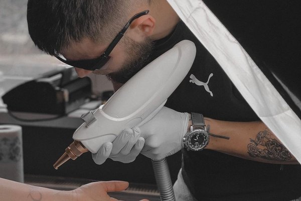 Tattoo removal in Wolverhampton